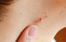 Лечение нитевидных папиллом