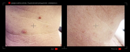 Удаление родинок 99 фото до и после процедуры