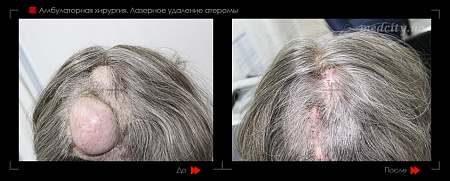 Лазерное удаление липомы 10 фото до и после процедуры