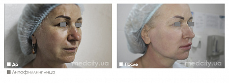 Липофилинг лица фото до и после процедуры