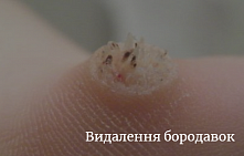 Видалення бородавок