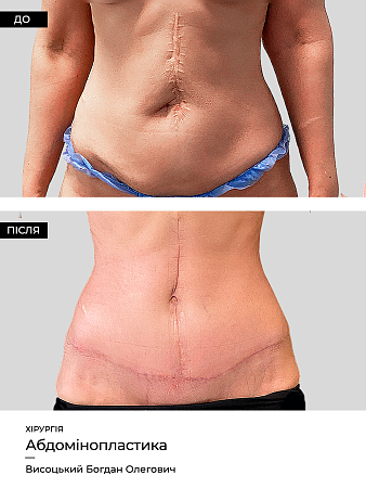 Абдоминопластика 5 фото до и после процедуры