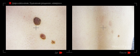 Удаление родинок 78 фото до и после процедуры