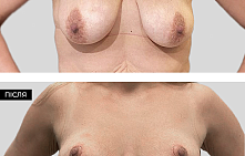 Подтяжка груди после родов