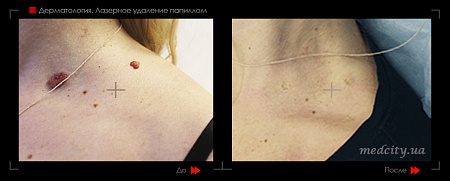 Удаление папиллом лазером фото до и после процедуры