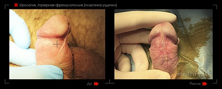 Френулотомия лазером (пластика уздечки) 4 фото до и после процедуры