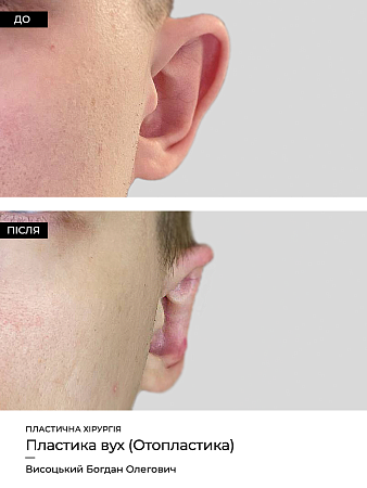 Отопластика 14 фото до и после процедуры