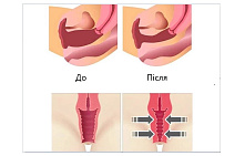 Синдром вагинальной релаксации