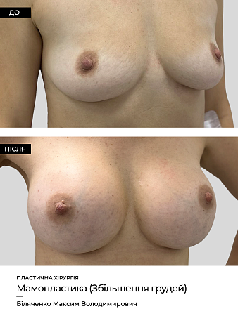 Маммопластика 31 фото до и после процедуры