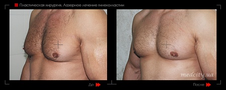 Гинекомастия 45 фото до и после процедуры