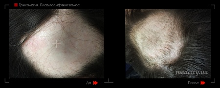 Плазмолифтинг волос 2 фото до и после процедуры