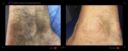 Склеротерапия 10 фото до и после процедуры