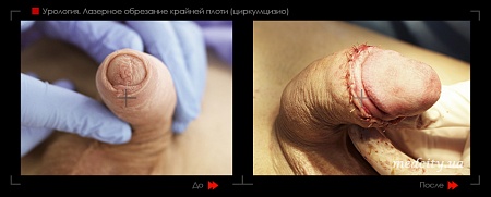 Лазерное обрезание крайней плоти 4 фото до и после процедуры