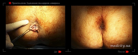 Удаление геморроя лазером 15 фото до и после процедуры