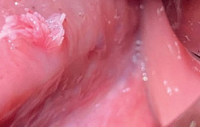 Папиллома влагалища