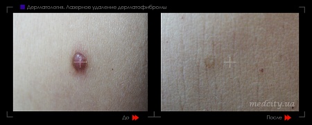 Лазерное удаление дерматофибромы фото до и после процедуры