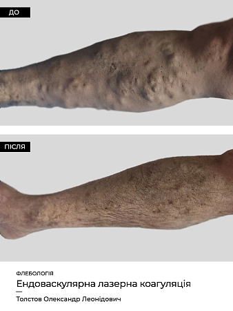 Эндоваскулярная лазерная коагуляция5 фото до и после процедуры