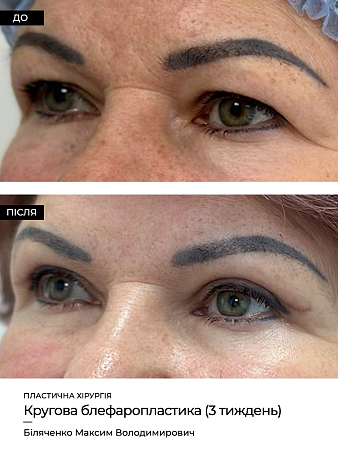 Блефаропластика фото до и после процедуры