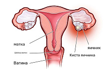 Фолликулярная киста