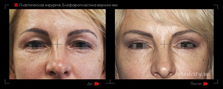 Блефаропластика 26 фото до и после процедуры