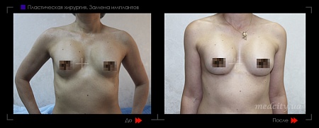 Замена грудных имплантов3 фото до и после процедуры