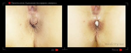 Удаление геморроя лазером 8 фото до и после процедуры