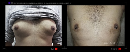 Гинекомастия 9 фото до и после процедуры