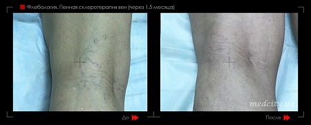 Склеротерапия 10 фото до и после процедуры
