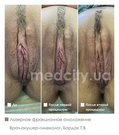 Лазерное фракционное омоложение фото до и после процедуры