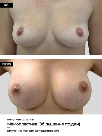Маммопластика 32 фото до и после процедуры