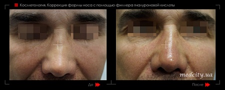 Контурная пластика носа фото до и после процедуры