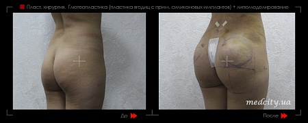 Глютеопластика (пластика ягодиц) 2 фото до и после процедуры