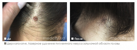 Удаление невуса фото до и после процедуры
