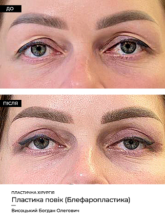 Блефаропластика фото до и после процедуры