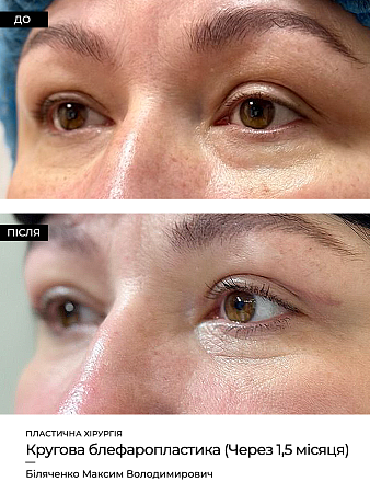 Блефаропластика 31 фото до и после процедуры