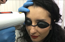 Удаление татуажа бровей лазером, фото до и после