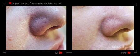 Лазерное удаление сосудов 24 фото до и после процедуры