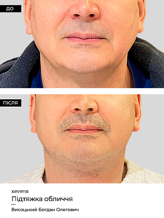 Podtyazhka Lica 1 фото до и после процедуры