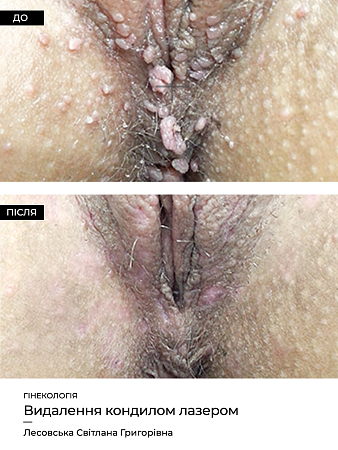 Удаление кондилом (гинек.) 5 фото до и после процедуры