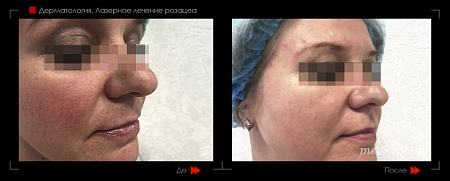 Лазерное лечение розацеа2 фото до и после процедуры