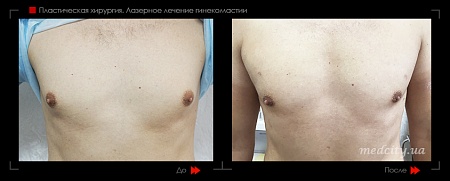 Гинекомастия 48 фото до и после процедуры
