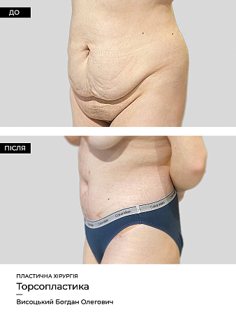 Пластика живота фото до и после процедуры