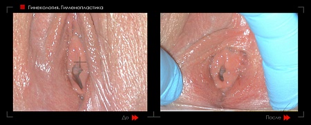 Гименопластика 2 фото до и после процедуры
