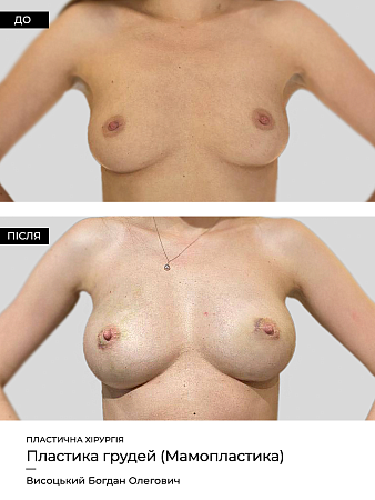 Маммопластика 30 фото до и после процедуры