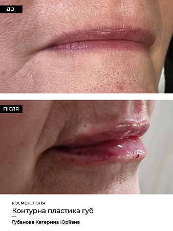 Увеличение губ 66 фото до и после процедуры
