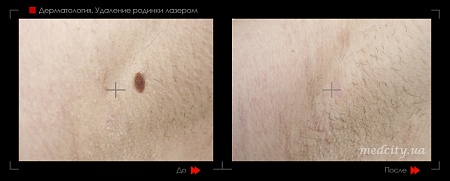 Удаление родинок 98 фото до и после процедуры