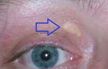 Лечение ксантелазмы