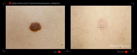 Удаление родинок 95 фото до и после процедуры