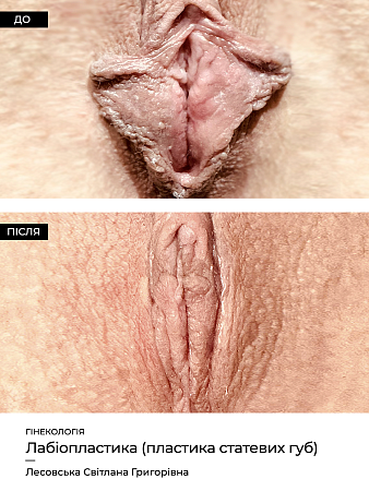 Лабиопластика12 фото до и после процедуры