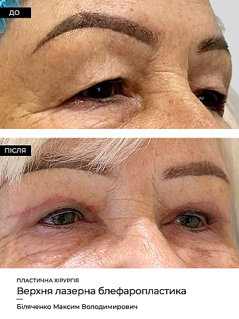 Surgery plastika 5 фото до и после процедуры